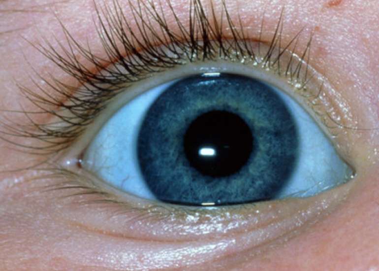 Severe Iron Deficiency Anemia presenting as Blue Sclera.